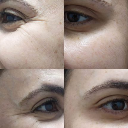 Clube do Botox SILVER